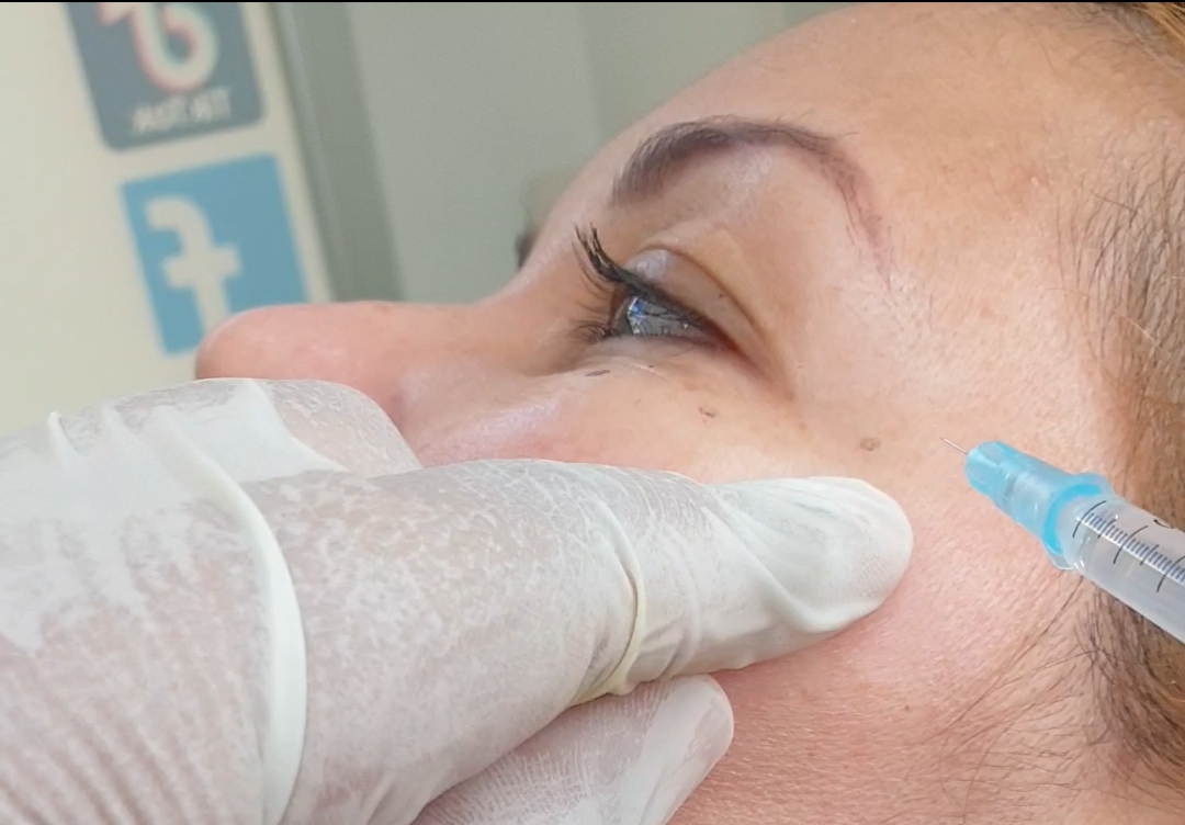 Toxina botulínica (bótox) – Centro Estético Valle